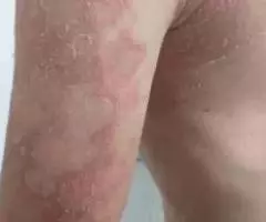 Кайыпов Айболот Кайырбекович врач дерматовенеролог - 4