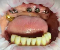 Имплантация зубов. Наш адрес г. Бишкек, ул. Байтик баатыра ... - 4