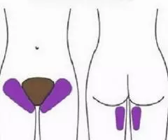 Шугаринг. Классическое бикини. - 2